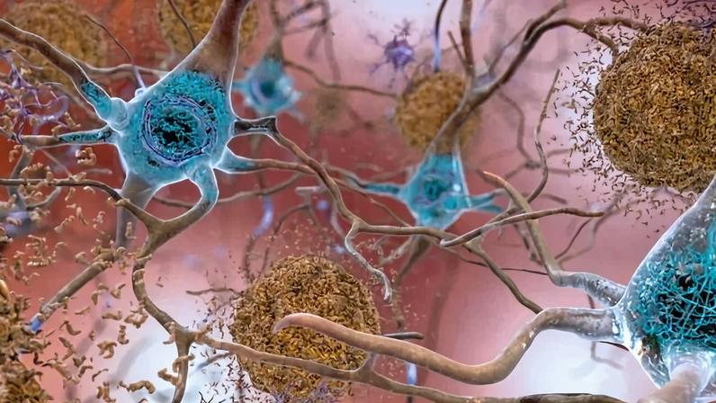 Um dos mecanismos fisiológicos da doença é o acúmulo da proteína beta-amiloide (em amarelo) no cérebro - (crédito: Flickr/Divulgação )