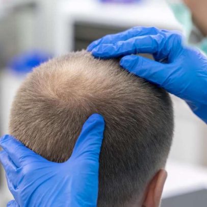 Medicina capilar avança, ampliando opções de tratamento