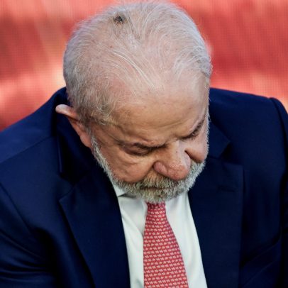 Lula fará retirada de queratose no couro cabeludo e infiltração no punho