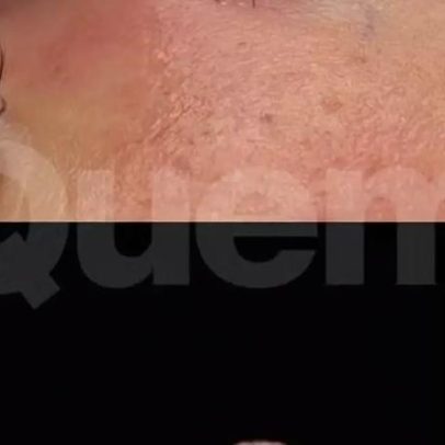 Rinoplastia de 4 horas de Rafaella Justus mostra resultado