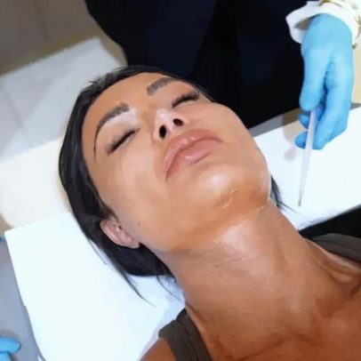 Gracyanne Barbosa faz procedimento invasivo no rosto e afirma não querer mais