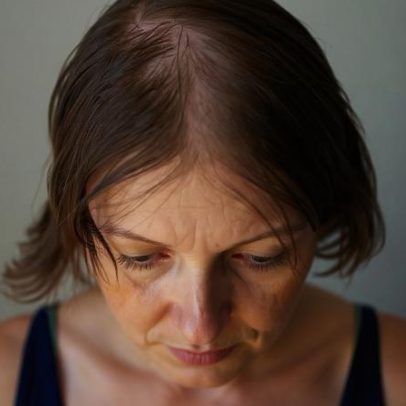 Calvície feminina: por que mais mulheres enfrentam o problema