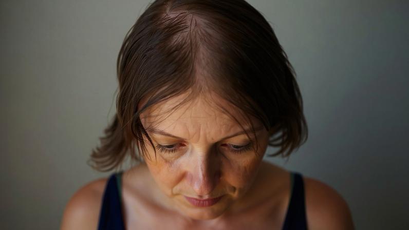 Entenda sobre a calvície feminina