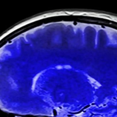 Nutriente desconhecido é vital para o desenvolvimento do cérebro