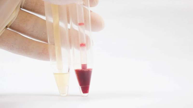 Essa mudança pode envolver pigmentos de alimentos, substâncias químicas de medicamentos ou, em situações mais delicadas, a presença de sangue, que tem o nome de hematúria – depositphotos.com / toeytoey