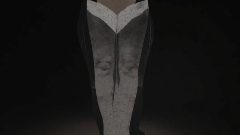 Doctors believe that lipedema results from weak connective tissue that allows fluid to leak into a patient’s fat layer.