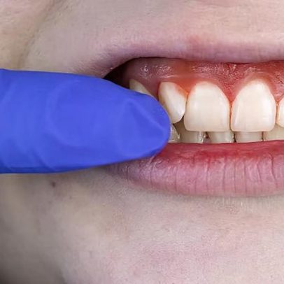 Gengivas saudáveis: hábitos que evitam sangramento ao passar o fio dental