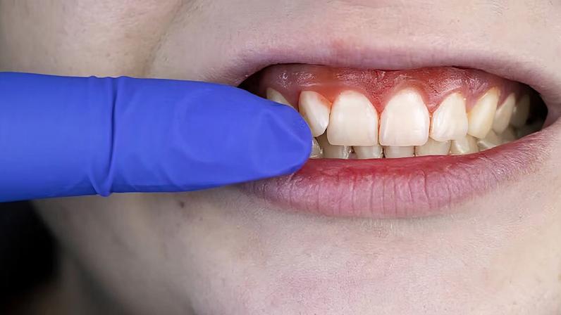 Gengivas saudáveis: hábitos que evitam sangramento ao passar o fio dental