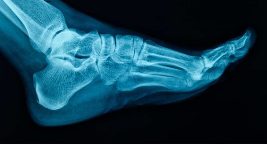 As intervenções cirúrgicas na região do pé são, em sua maioria, motivadas por traumas, desgastes e condições adquiridas, como o joanete e o pé plano