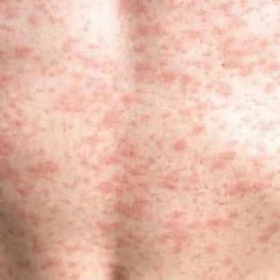 Sarampo: quão contagioso é e quais são os sintomas