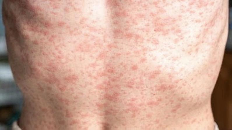 The measles virus lives in the nose and throat mucus of infected people.