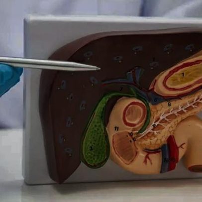 Crise de vesícula pode evoluir para infecção grave se não tratar