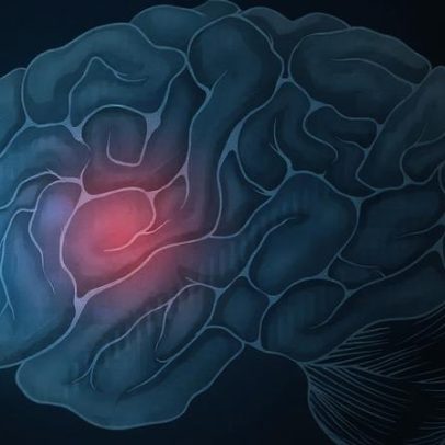 Anticoagulante reduz risco de AVC sem aumentar sangramentos, aponta estudo