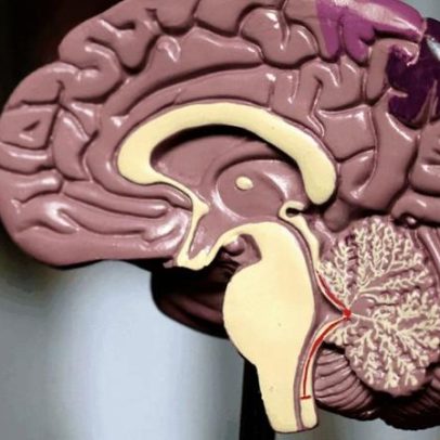 Remédio para Alzheimer chega ao Brasil com custo de até R$ 11 mil por mês