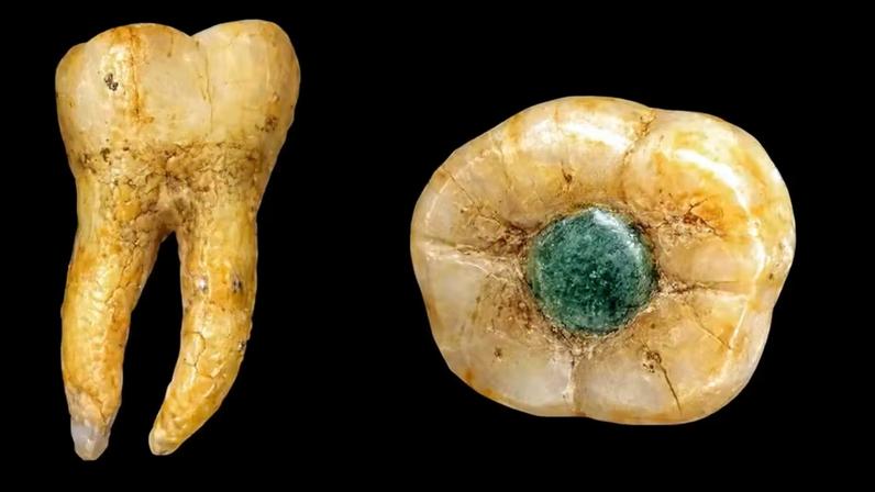 Dente foi encontrado com uma pedra verde incrustada, possivelmente uma jadeíta
