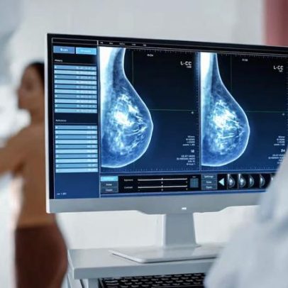Cirurgia no câncer de mama: quando é indicada e seu impacto.