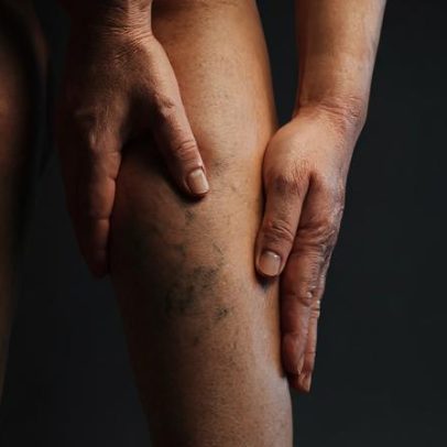 Varizes: além da estética, requerem tratamento médico