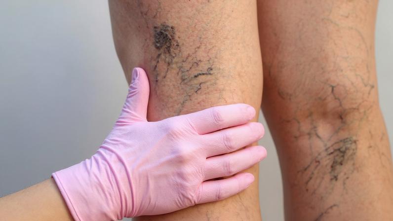 Vitamina D pode ajudar na saúde das veias. (Foto: Getty Images via Canva)
