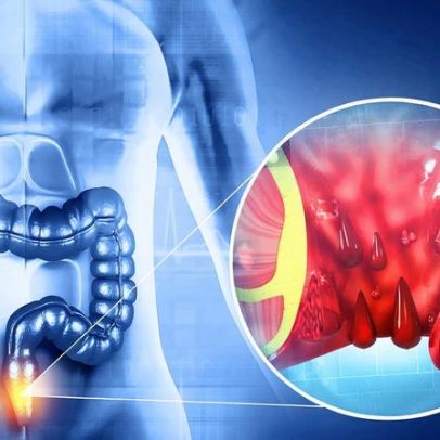 Hemorroidas: o padrão da dieta importa mais que alimento isolado