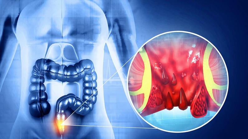 Ilustração médicamostra a formação das hemorroidas