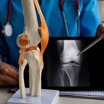 Alimentação pode influenciar avanço da artrite nos joelhos