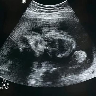 Justiça do RS cancela júri de mulher acusada de abortar em banheira