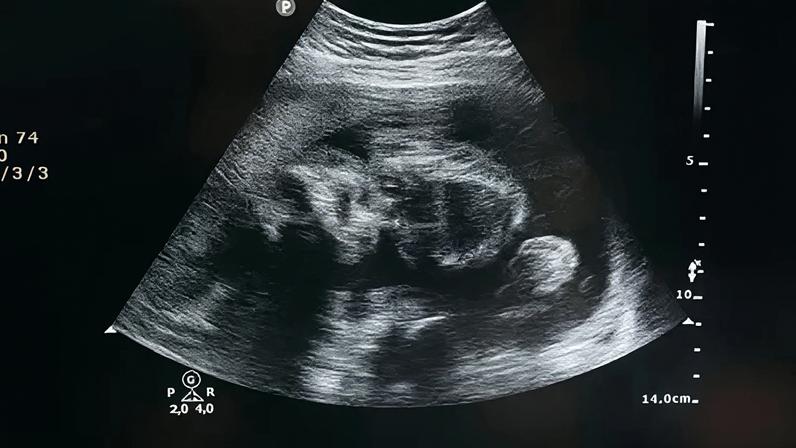 A 1ª Câmara Criminal do Tribunal de Justiça do Rio Grande do Sul (TJRS) decidiu, por maioria, cancelar o júri popular de uma mulher acusada de aborto provocado