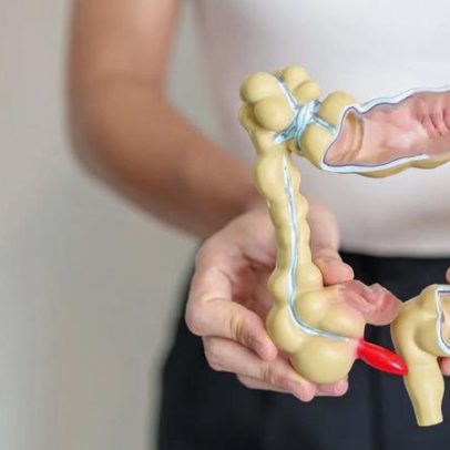 Ignorar etapa da dieta FODMAP pode prolongar a Síndrome do Intestino Irritável