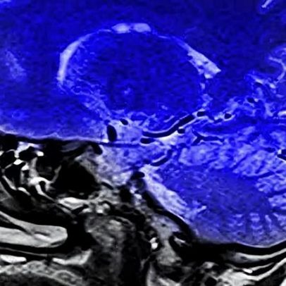 Nutriente pouco conhecido é vital para o desenvolvimento cerebral
