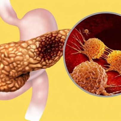 Gene descoberto pode acelerar a disseminação do câncer pancreático