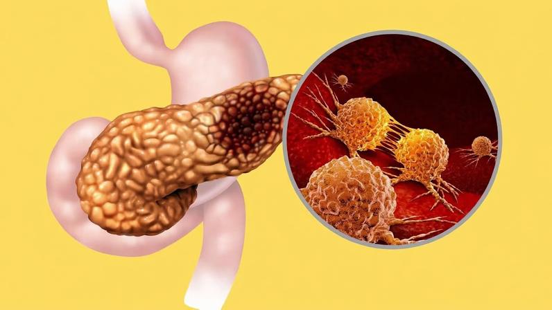 Gene descoberto pode acelerar a disseminação do câncer pancreático