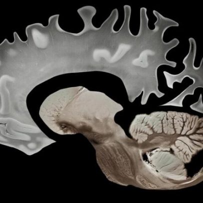 Gás com cheiro de ovo podre pode proteger o cérebro contra Alzheimer