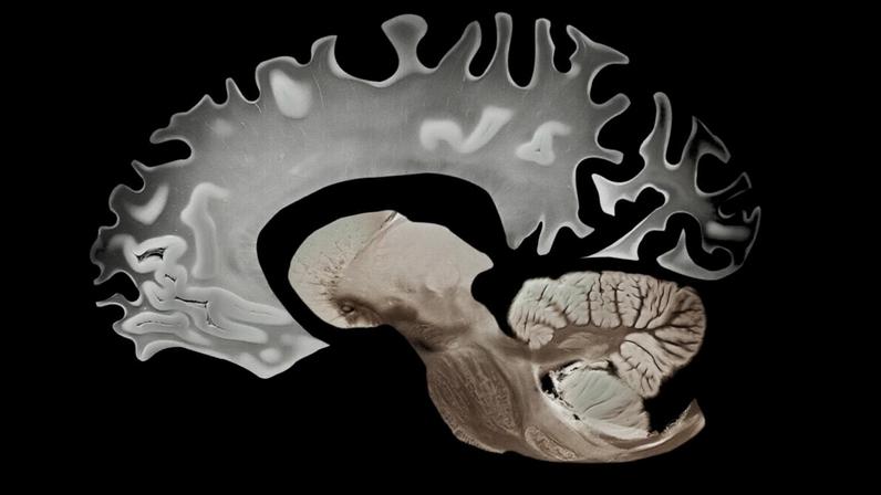 Gás com cheiro de ovo podre pode proteger o cérebro contra Alzheimer