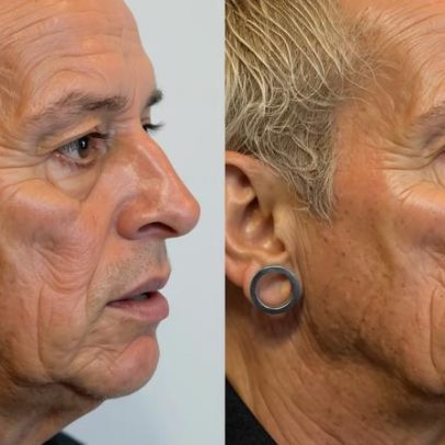 Ex-Fazenda Walério Araújo passa por transformação facial