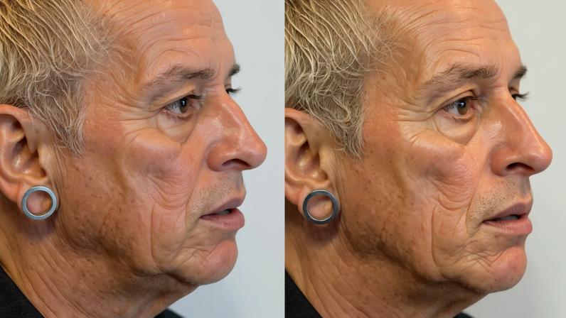 Ex-Fazenda Walério Araújo passa por transformação facial