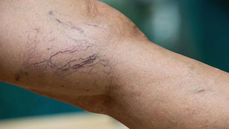 Três alimentos comuns ajudam no combate às varizes, aponta estudo