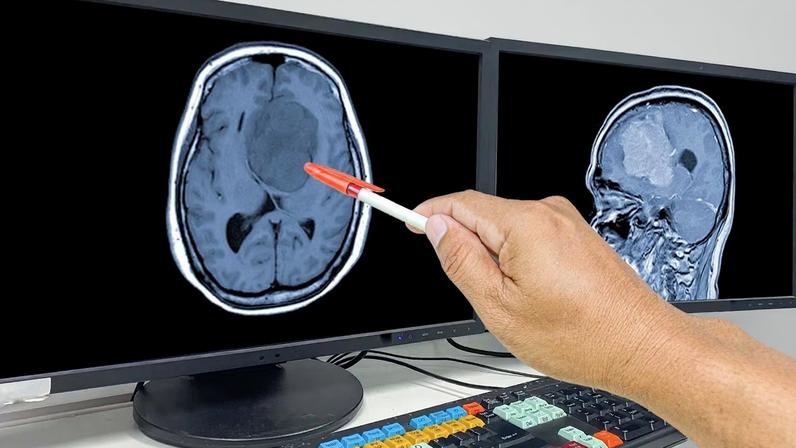 Diagnóstico de glioblastoma ainda traz grandes desafios. (Foto: Getty Images via Canva)