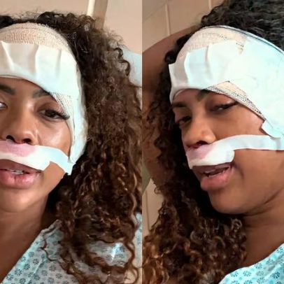 Marvvila retoma shows após cirurgias de tumor benigno e correção nasal