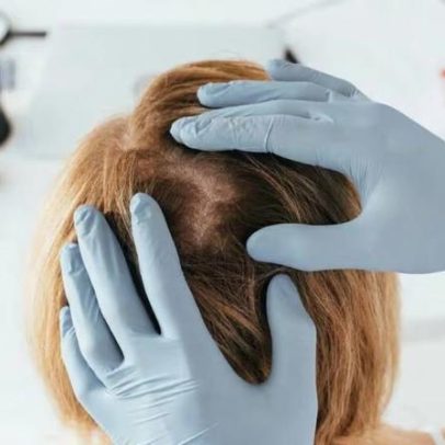 Caspa sob controle com estratégias eficientes para o couro cabeludo