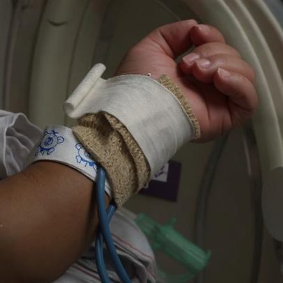 Como a IA monitora convulsões silenciosas em bebês prematuros