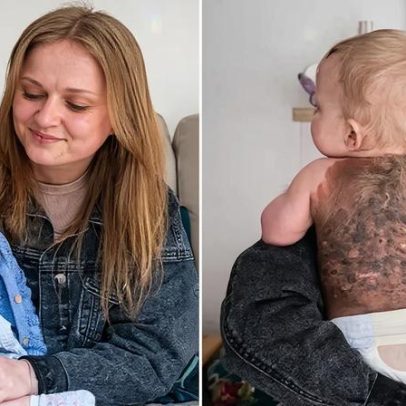 Bebê nasce com doença rara que provoca manchas escuras na pele