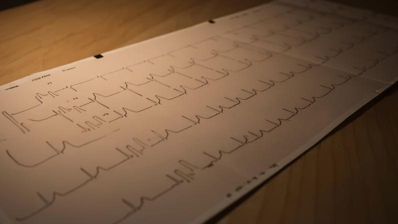 Eletrocardiograma é um dos exames que pode identificar arritmias