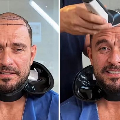 Diogo Nogueira faz transplante capilar e revela novo visual