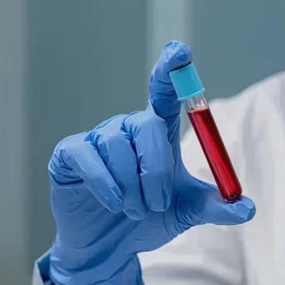Exame de sangue com IA facilita diagnóstico precoce de hanseníase