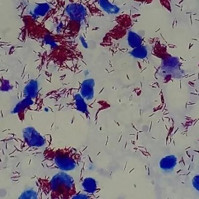Exame de sangue com IA acelera diagnóstico precoce da hanseníase