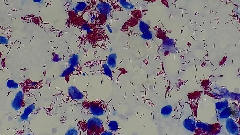 Amostra de lesão de pele com Mycobacterium leprae (os fiapos vermelhos), vista ao microscópio em aumento de 1.000 vezes