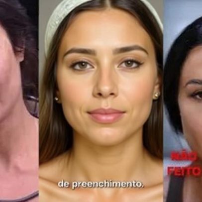 Ex-BBBs como Gracyanne e Kerline reverteram procedimentos estéticos