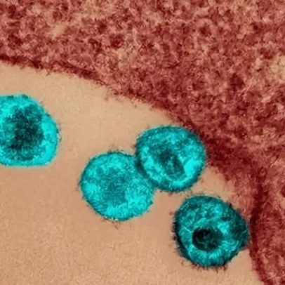 Nova injeção para HIV supera terapia oral diária, aponta estudo