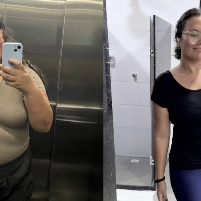 Especialista em marketing relata cáries extensas após cirurgia bariátrica