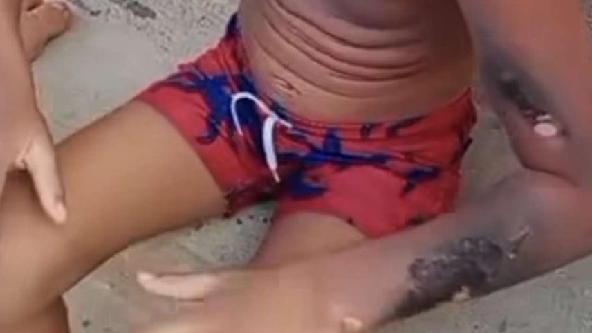 A criança sofreu queimaduras em diversas partes do corpo dentro da própria residência